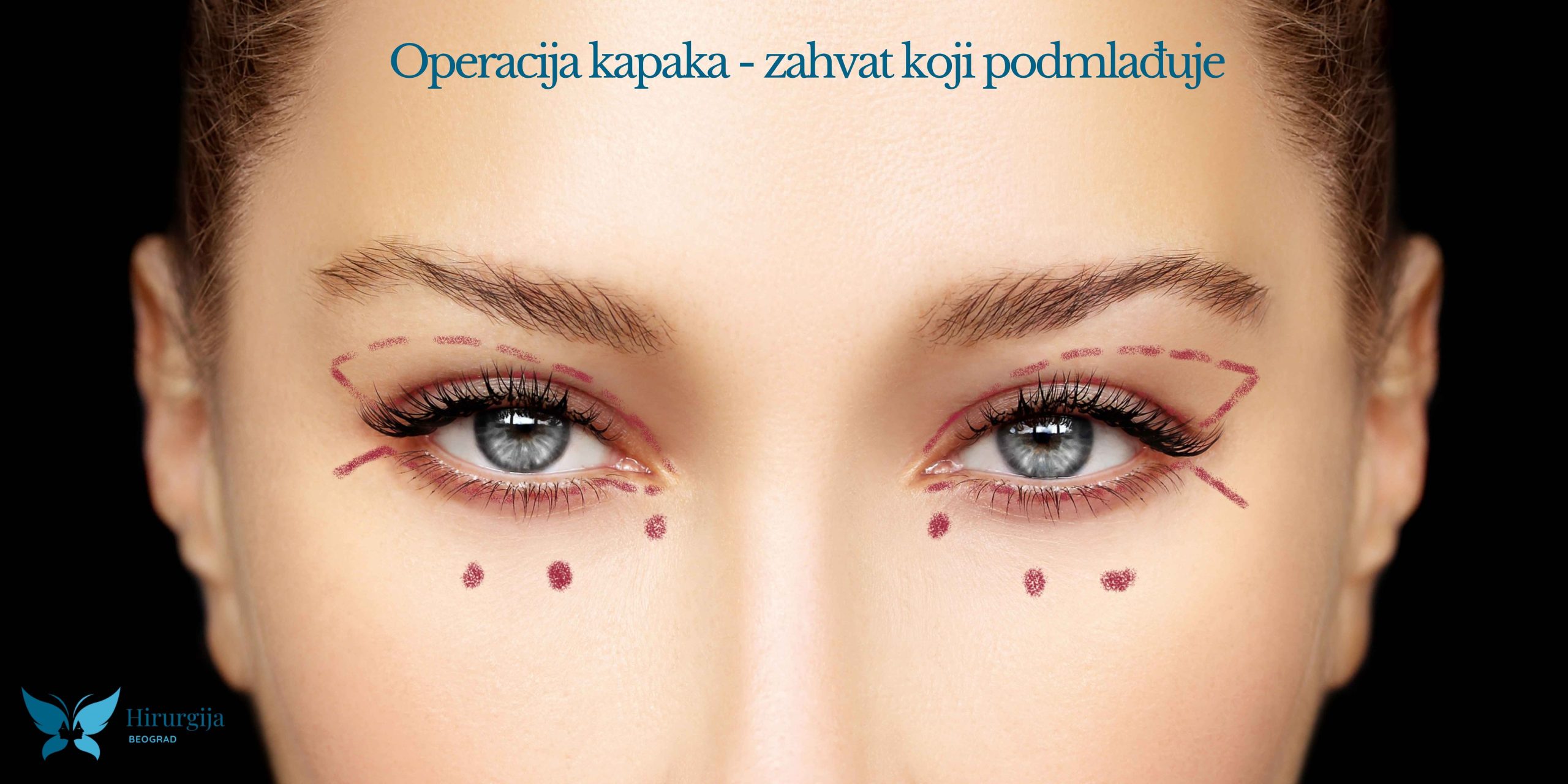 Operacija kapaka ili blefaroplastika - zahvat koji podmlađuje