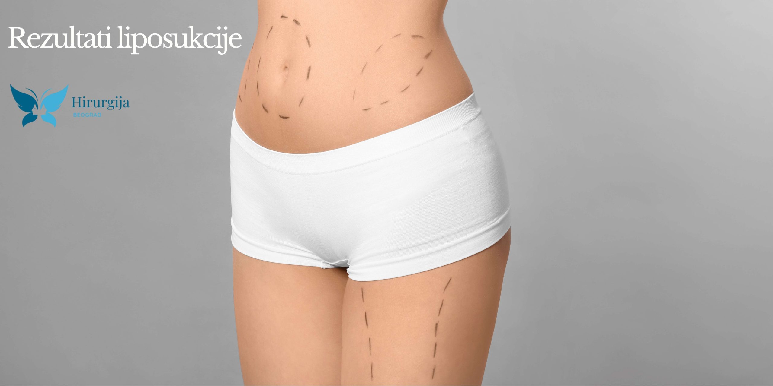 Rezultati liposukcije: Kada možete očekivati konačne promene?